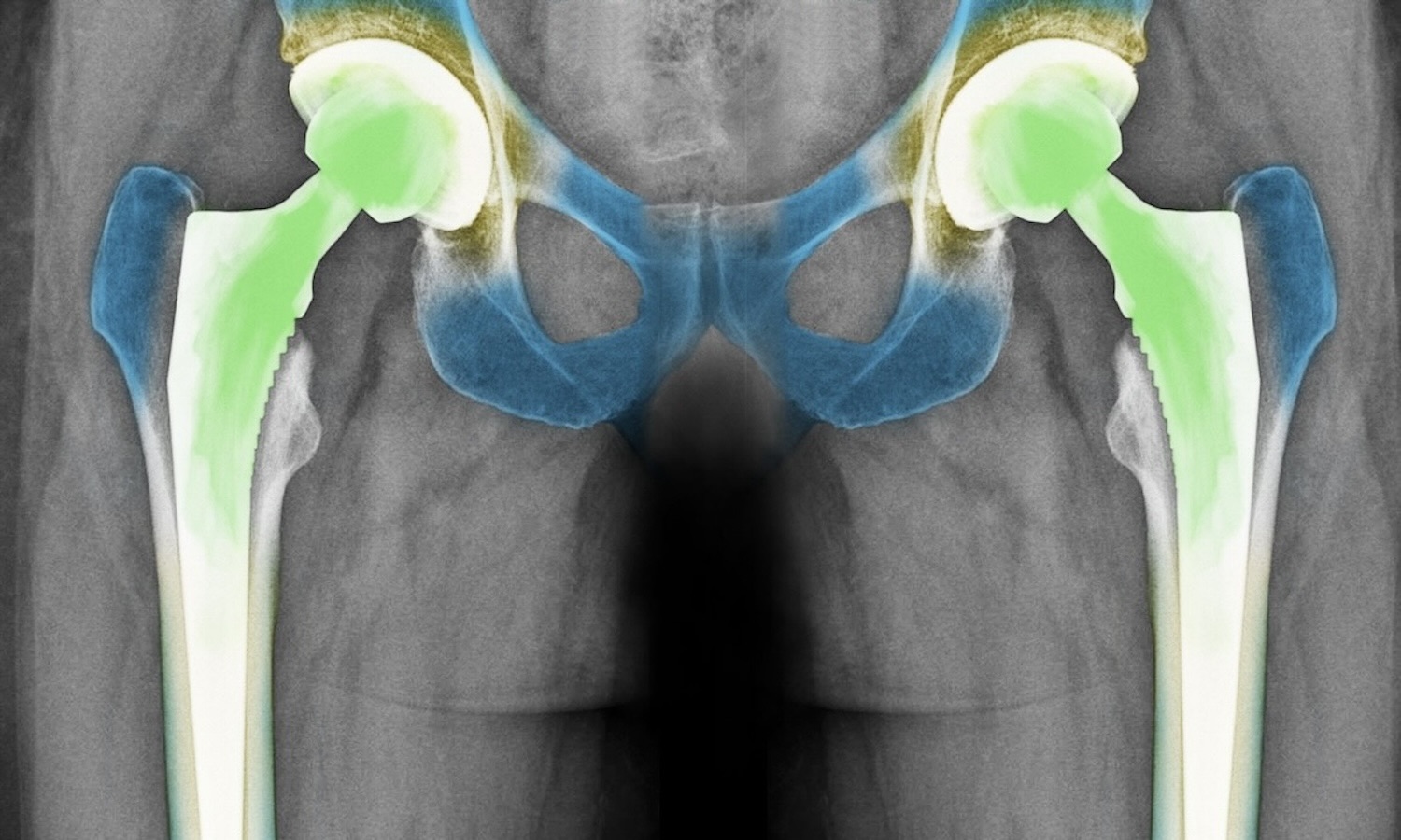 Hüft Prothese Arthrose Clinic Zürich