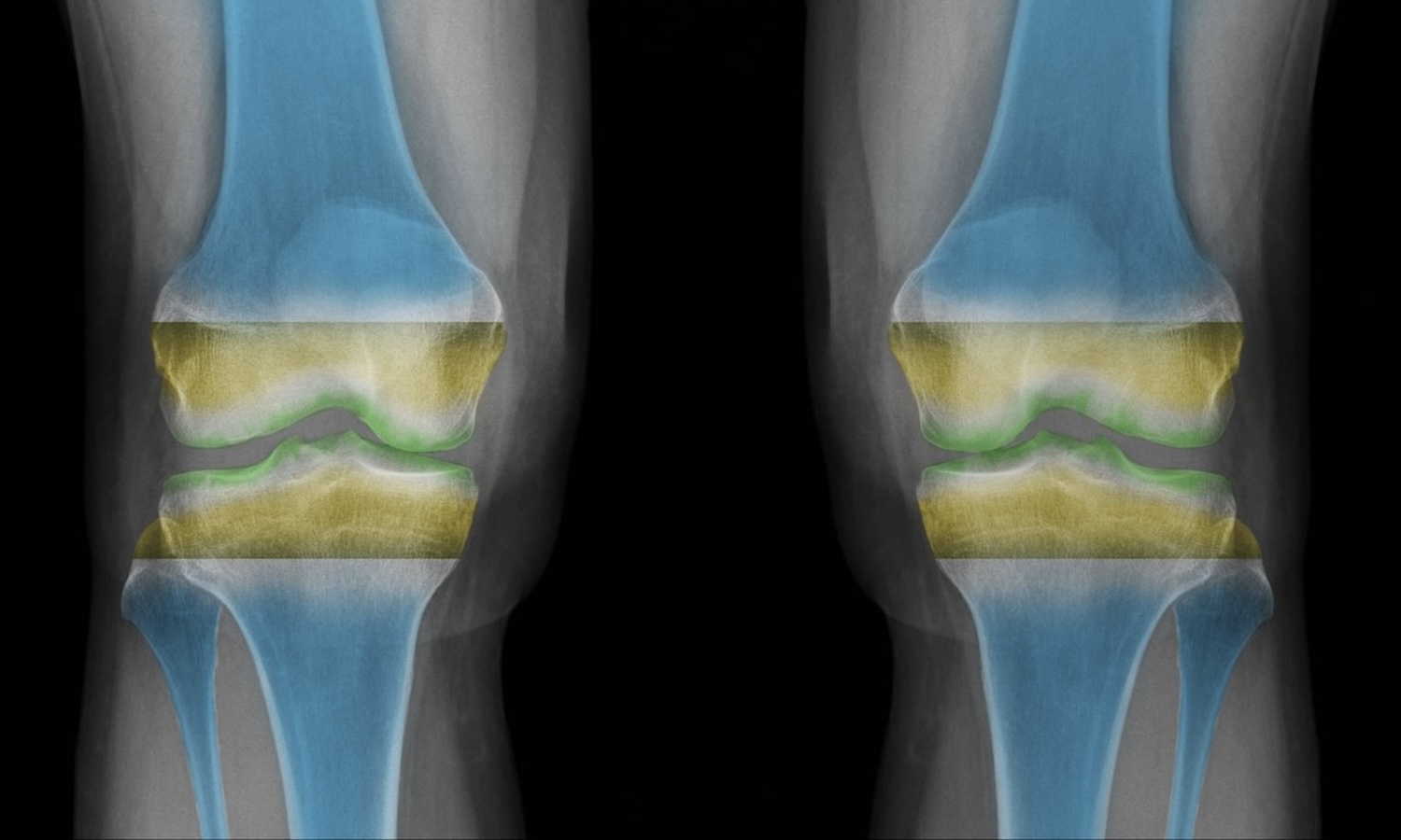 Gesundes Knie Arthrose Clinic Zürich