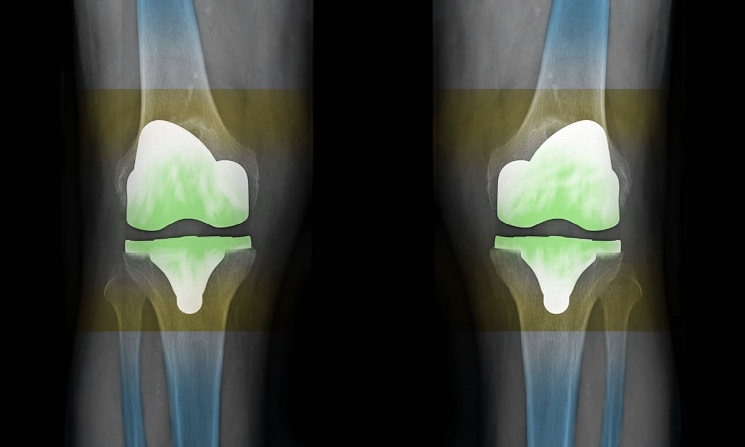 Knieprothese Arthrose Clinic Zürich