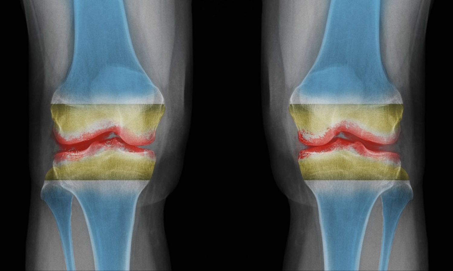 Kniegelenk Arthrose Clinic Zürich