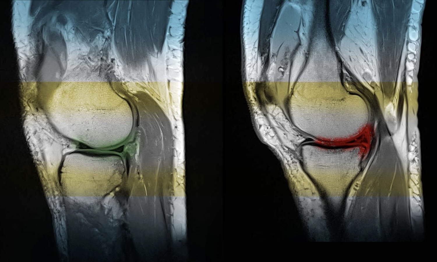 Meniskus Knie Arthrose Clinic Zürich